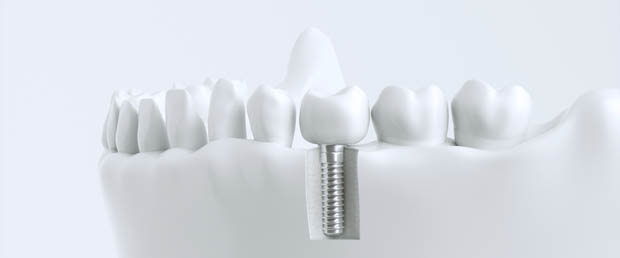 Fachzahnarztpraxis für Zahnimplantologie in Euskirchen Bild